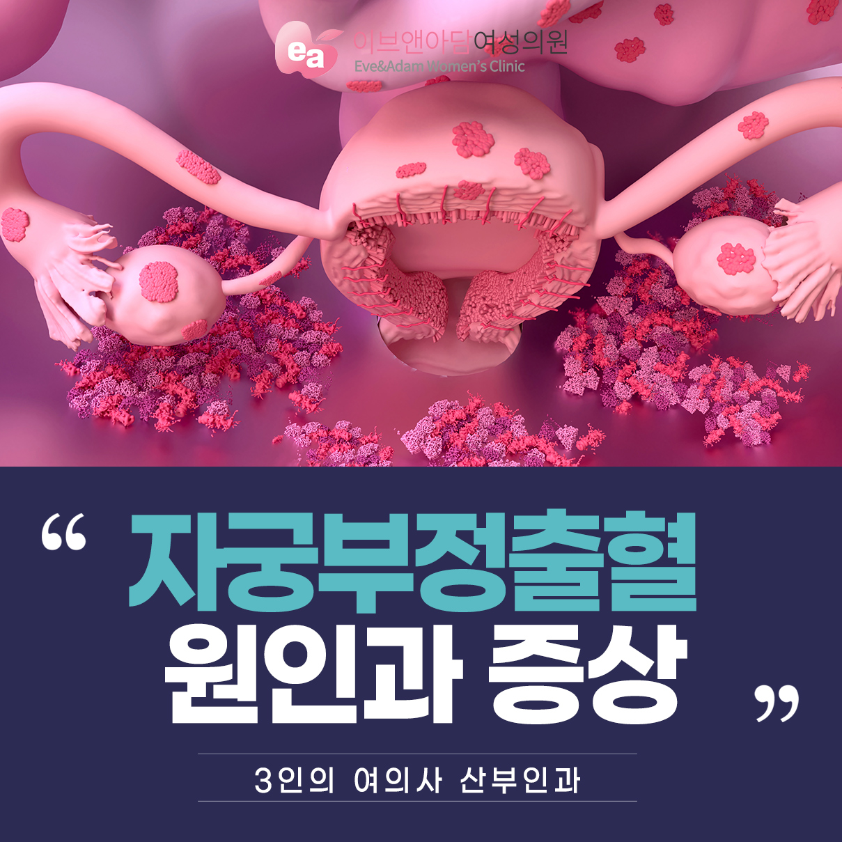 자궁근종